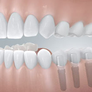 Zahnimplantate von Dr. Kurth & Partner in Berlin-Spandau schließen größere Zahnlücken.