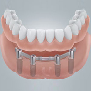 Vier Implantate halten dank Verbindungen die neuen festen Zähne besonders sicher.