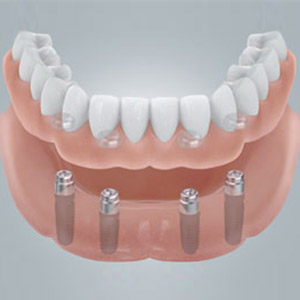 Der zahnlose Kiefer erhält in kurzer Zeit neue feste Zähne.