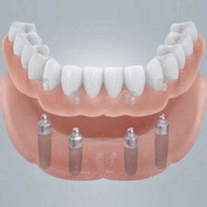 Vier Implantate geben neuen Zähnen festen Halt.