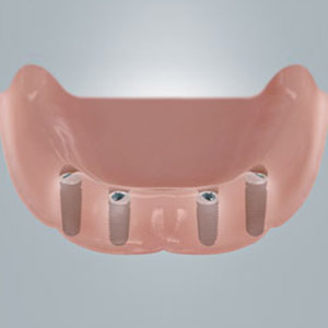Vier Implantate für den festen Halt von neuen Zähnen.