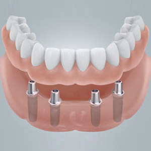 Vier Implantate für neue feste Zähne an einem Tag in Berlin-Spandau.