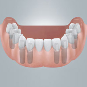 Feste neue Zähne für den zahnlosen Unterkiefer.