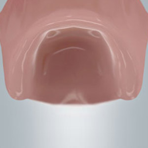 Beispiel für einen zahnlosen Kiefer, der mit einer vollständigen Zahnreihe versorgt wird.