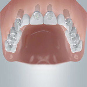 Vier bis sechs Implantate für den festen Halt von neuen Zähnen.