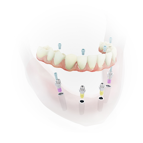 Grafik zeigt, wie 4 Implantate feste Zähne aus Berlin-Spandau halten. 