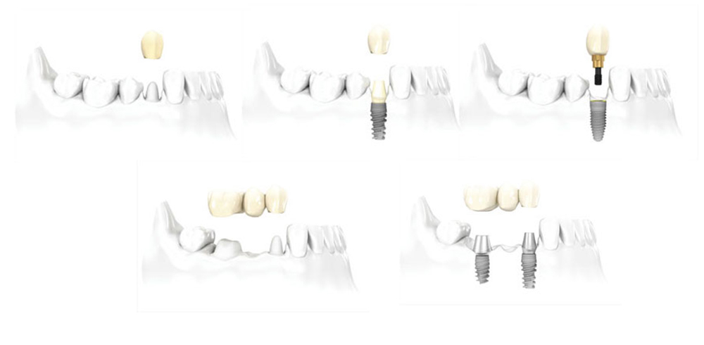 Modell wie Zahnersatz auf Implantaten eine Zahnlücke schließt. 