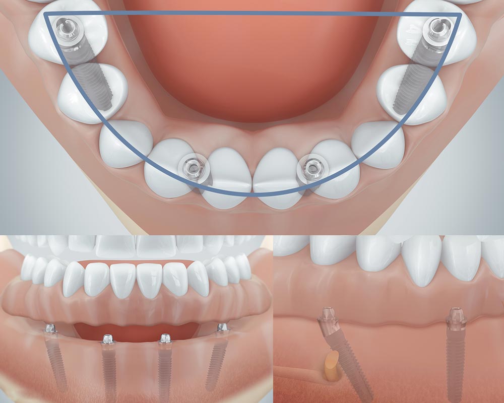 Vier Implantate für feste Zähne aus Berlin-Spandau. 