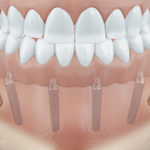Vier Implantate im Unterkiefer geben dem zahnlosen Kiefer wieder eine vollständige Zahnreihe.