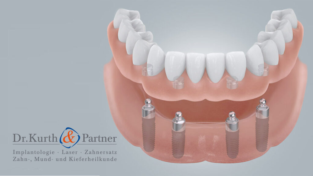 Modell für feste Zähne für den zahnlosen Kiefer in Spandau.